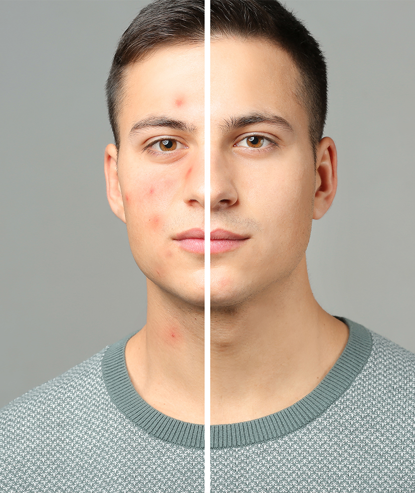 Photo of a man before and after acne treatments