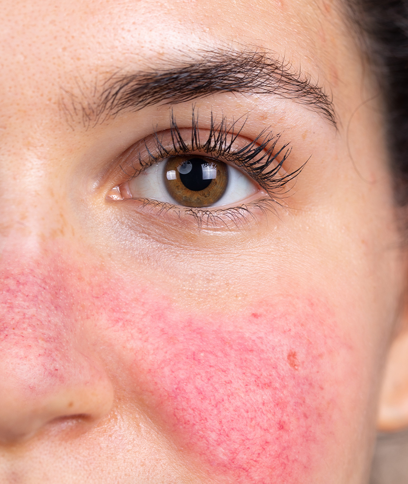 Photo of rosacea on a woman's cheek