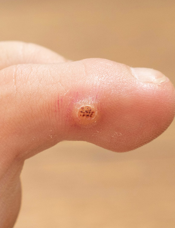 Photo of warts on a person's toe