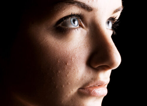 Photo of a woman with acne on her cheek
