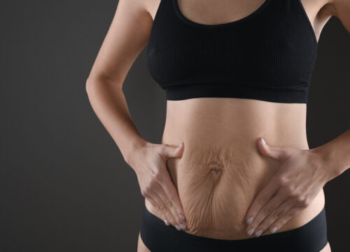 Photo of loose skin on a woman's stomach