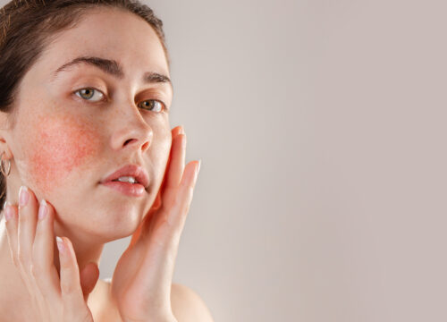 Photo of a woman with rosacea