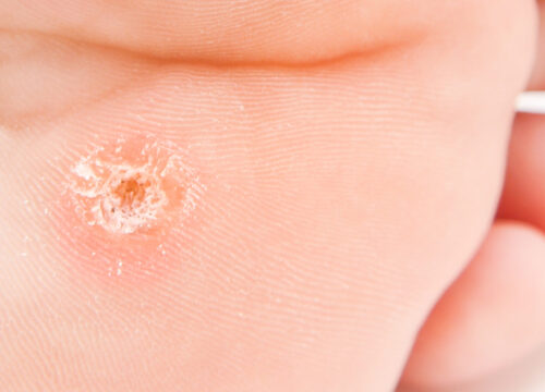 Photo of a wart on a person's foot
