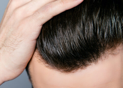 Photo of a man's hair and hairline