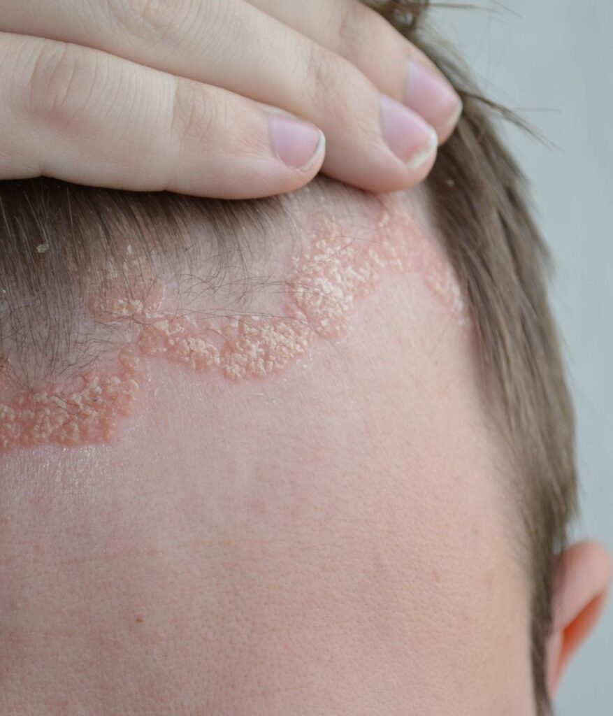 Photo of a psoriasis rash on a man's scalp