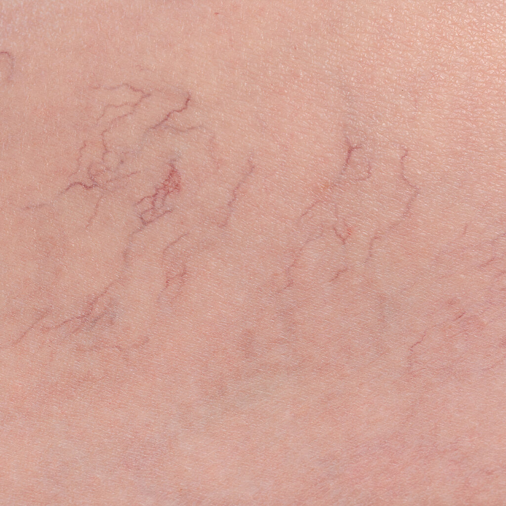 Close-up photo of spider veins
