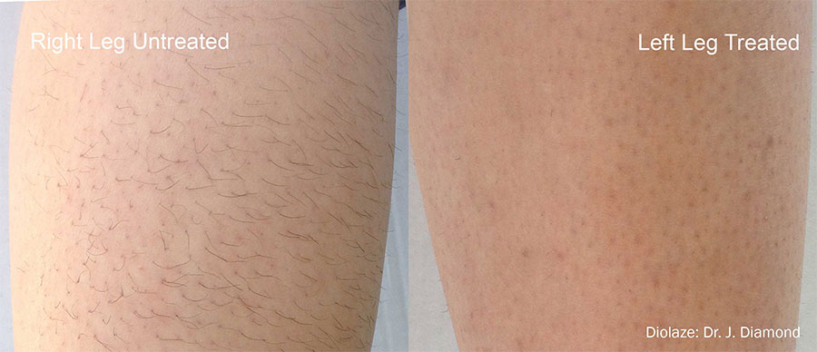 Before and after laser hair removal results